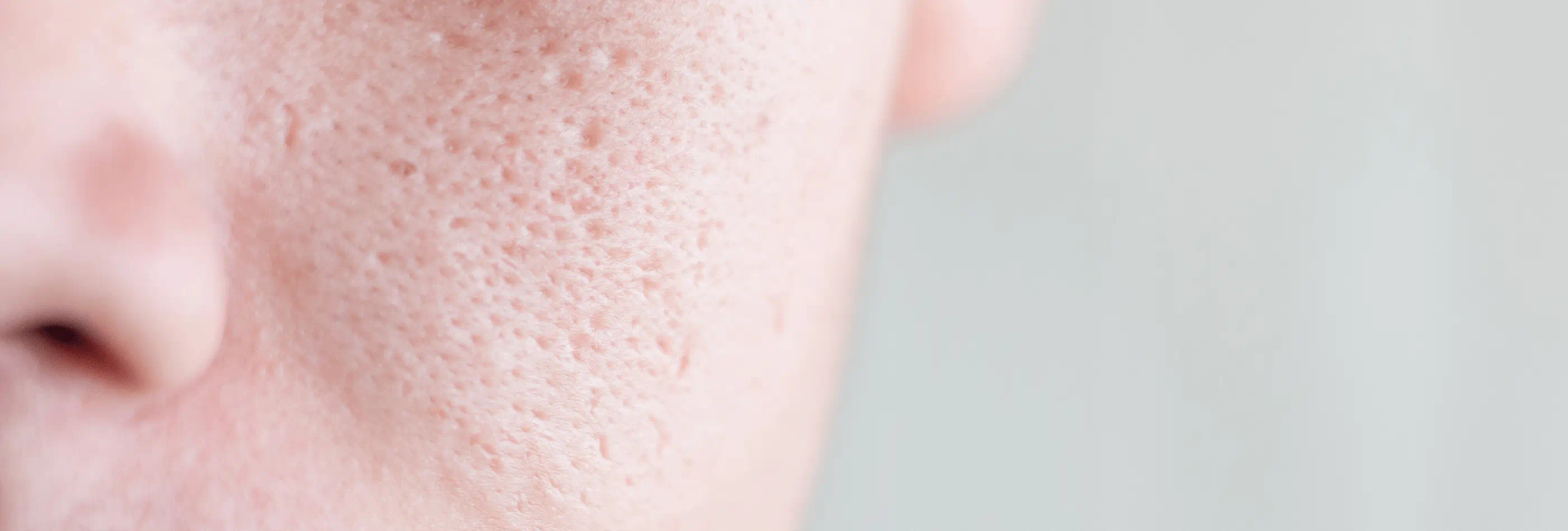 Clogged pores treatment & causes Eucerin